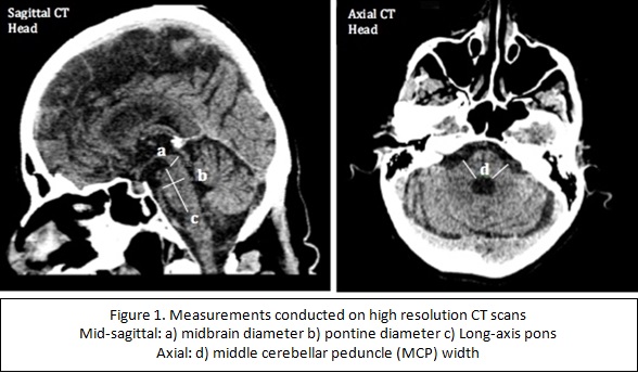 胸部CT・MRIマニュアル 1 Brain injury after cardiac arrest: pathophysiology